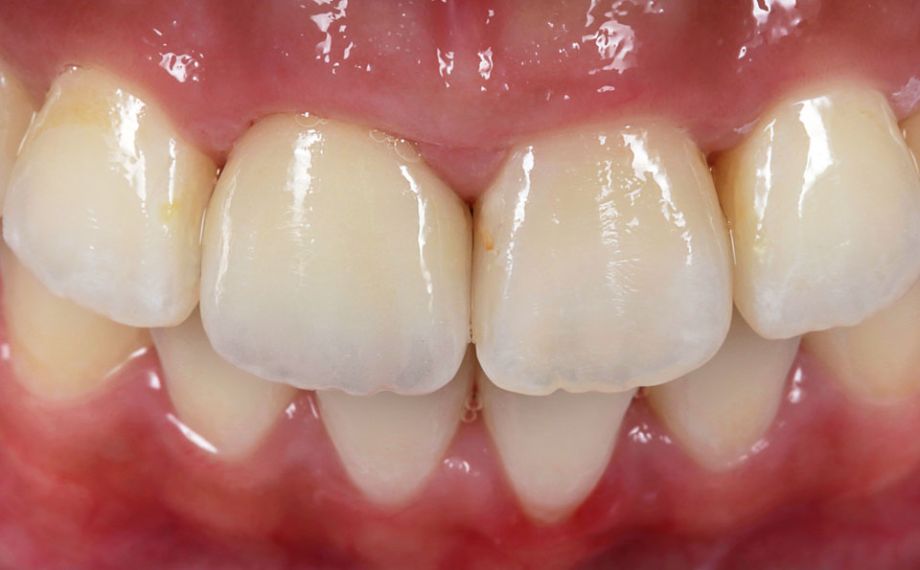 Fig. 10: Result: By positioning and rotating the crown in the multichromatic VITABLOCS TriLuxe forte, the translucency and shade gradient could be reproduced.