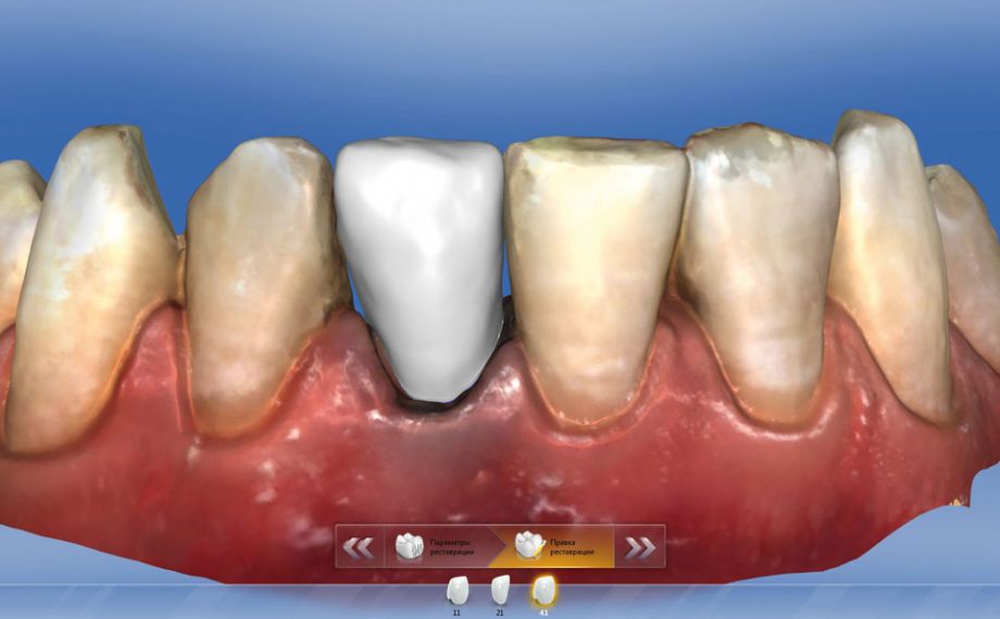 Fig. 8: The designed monolithic crown was fabricated from the zirconia-reinforced glass ceramic 0M1 VITA SUPRINITY PC.