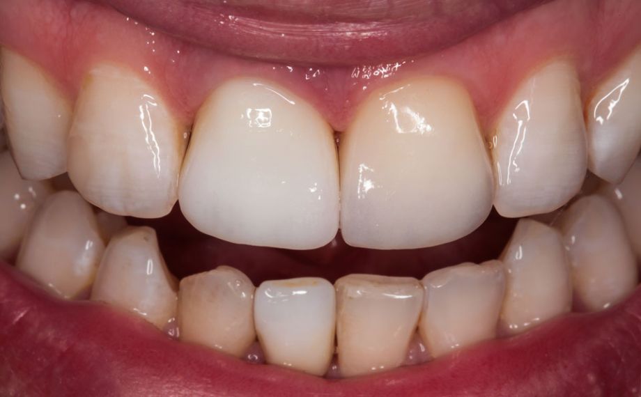 Fig. 10: After crystallization firing, the two glass-ceramic full crowns were tried in.