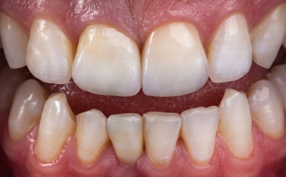 Fig. 11: The VITABLOCS crowns individualized with VITA AKZENT Plus were also fully adhesively cemented.