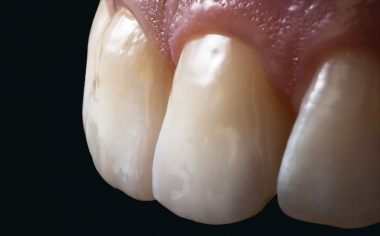 Fig. 13: The morphology and surface texture of the two all-ceramic restorations can no longer be distinguished from the natural adjacent teeth.