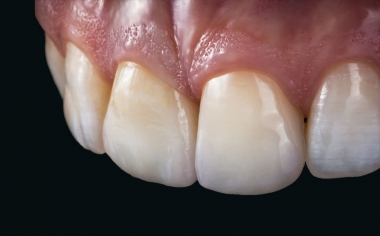 Fig. 14: The different choice of material for the upper middle incisors results in a highly esthetic result with a natural play of shade and light.