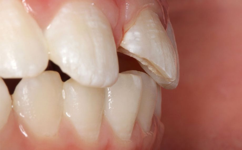 Case study 1Fig. 2: The pulp was not opened and could be protected using adhesive wound dressing.