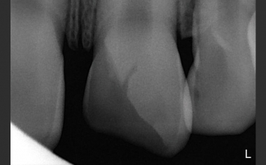 Case study 1Fig. 4: A radiological examination showed no opening of the pulp.