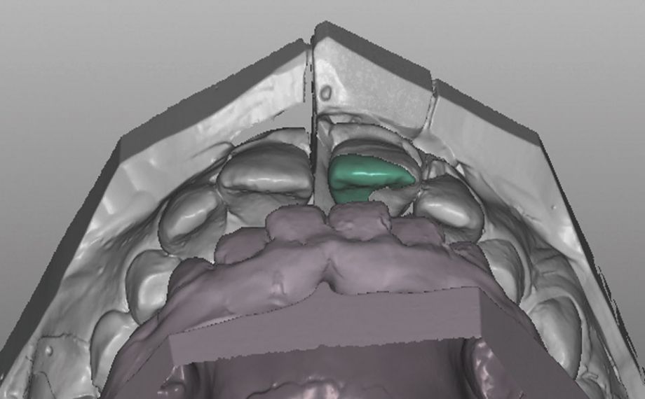 Case study 1Fig. 8: Thanks to the low minimum layer thickness, it was possible to construct a defect-oriented contact area.