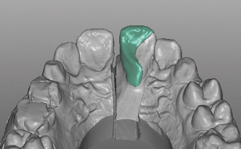 Case study 1Fig. 9: The defect-oriented construction of the palatal hybrid-ceramic restoration. 