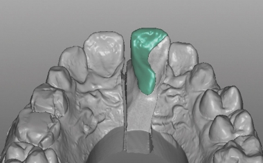 Case study 1Fig. 9: The defect-oriented construction of the palatal hybrid-ceramic restoration. 