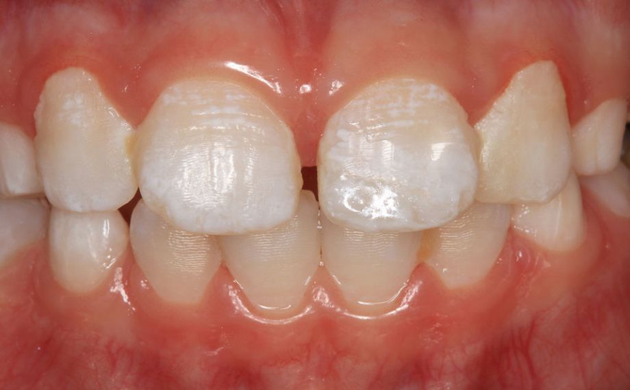 Case study 1Fig. 11: Thanks to the precise grinding results, the restoration was perfectly aligned with the defect.