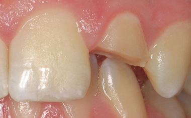 Case study 2Fig. 3: The minimally invasive marginal preparation enabled long-lasting anchoring of the restoration.