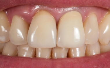 Fig. 1: The initial situation with lifeless, metal-ceramic crowns in the esthetic zone.