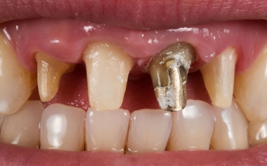 Fig. 2: Full crown preparation for the new, all-ceramic crowns.