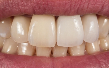Fig. 4: In the first step, the chroma of crown 21 did not have an optimal match with the rest of the dentition.