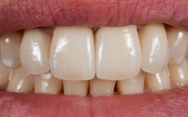 Fig. 6: The final esthetic results after the self-adhesive fixation of the crowns.