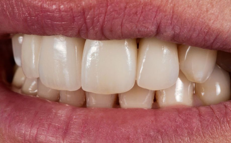 Fig. 7: The harmonious integration of the all-ceramic crowns.