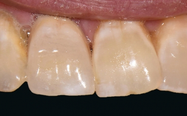 Fig. 8: Result: The detailed view clearly illustrates the recreation of all the nuances of the natural teeth.