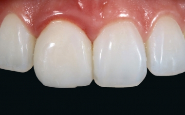 Fig. 2: The crown on tooth 11 was lifeless, showing no photo-optical effects.