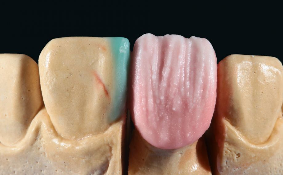 Fig. 6: After the anatomical cut-back, EFFECT CHROMA 2 (sand beige) was applied to the incisal area.