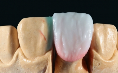 Fig. 8: To complete the enamel layer, a 2:1 mixture of ENAMEL (ENL) and NEUTRAL was added.