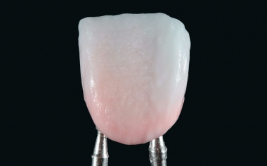 Fig. 9: The crown was carefully removed from the master model and the proximal areas were completed.